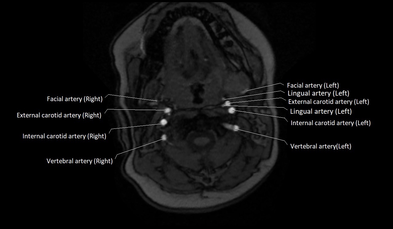 Carotid artery anatomy axial 3T image 19.jpg